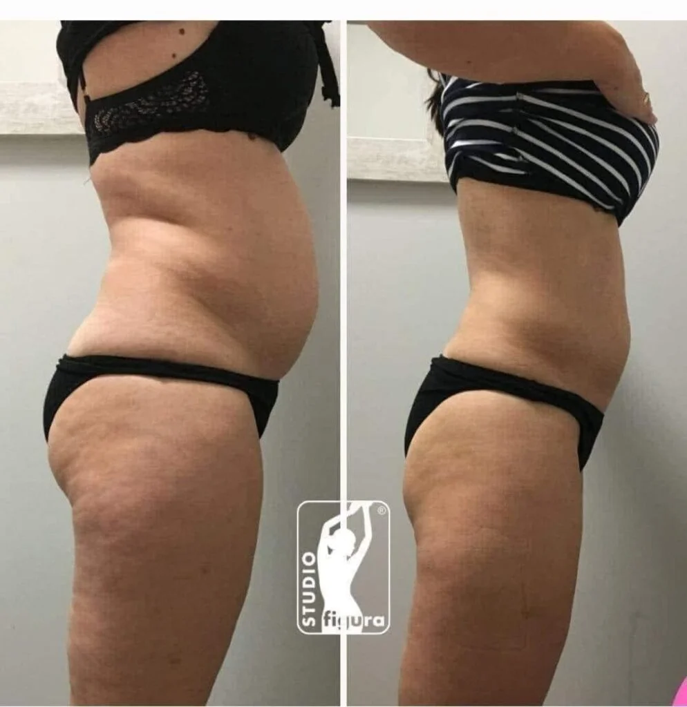 Efekt przed i po Lipolaser