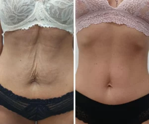 Efekty zabiegów lipolaserem