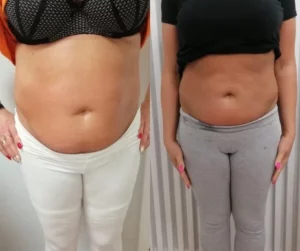 Efekty zabiegów lipolaserem