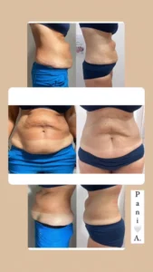 Efekty zabiegów lipolaserem