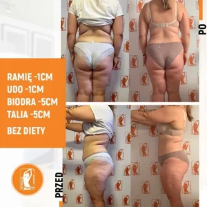 Efekty zabiegów lipolaserem