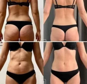 Efekty zabiegów lipolaserem