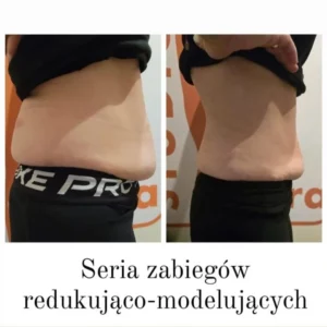 Efekty zabiegów lipolaserem