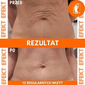 Efekty zabiegów lipolaserem