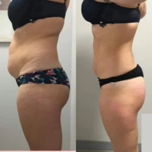 Efekty zabiegów lipolaserem