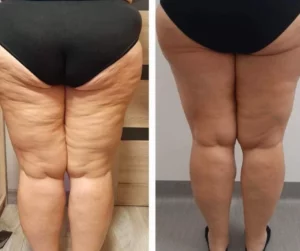 Efekty zabiegów lipolaserem